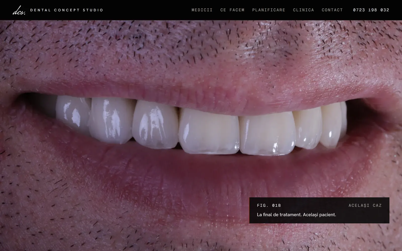 Site-ul Dental Concept Studio: fațetele au intrat în zâmbetul final, fotografiat pe fond negru.